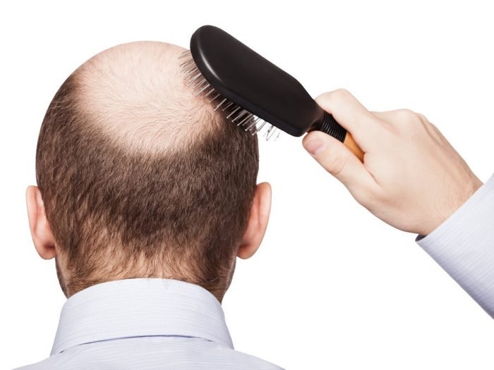  cure your baldness